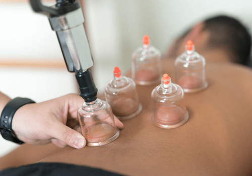 Cupping Therapy