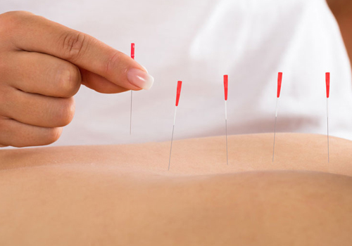 Dry Needling
