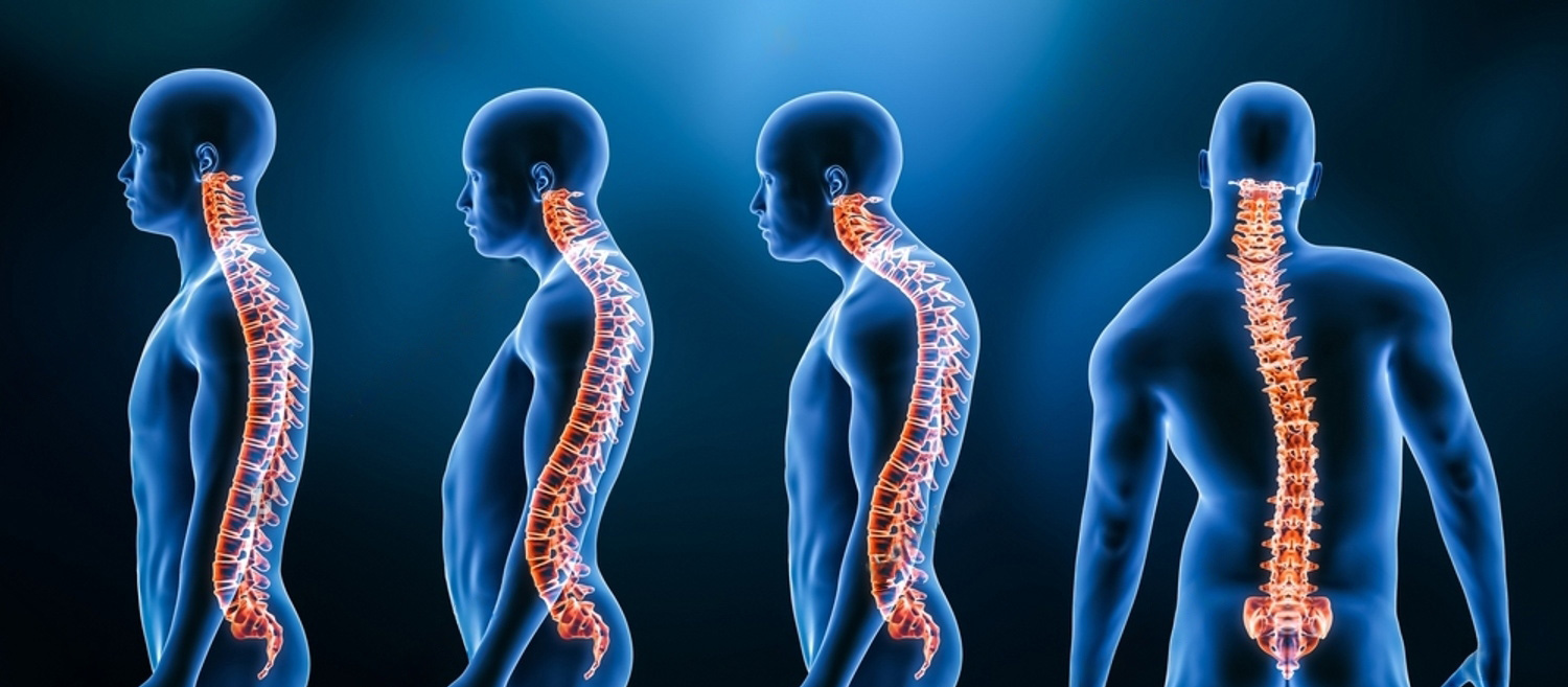 scoliosis-treatment
