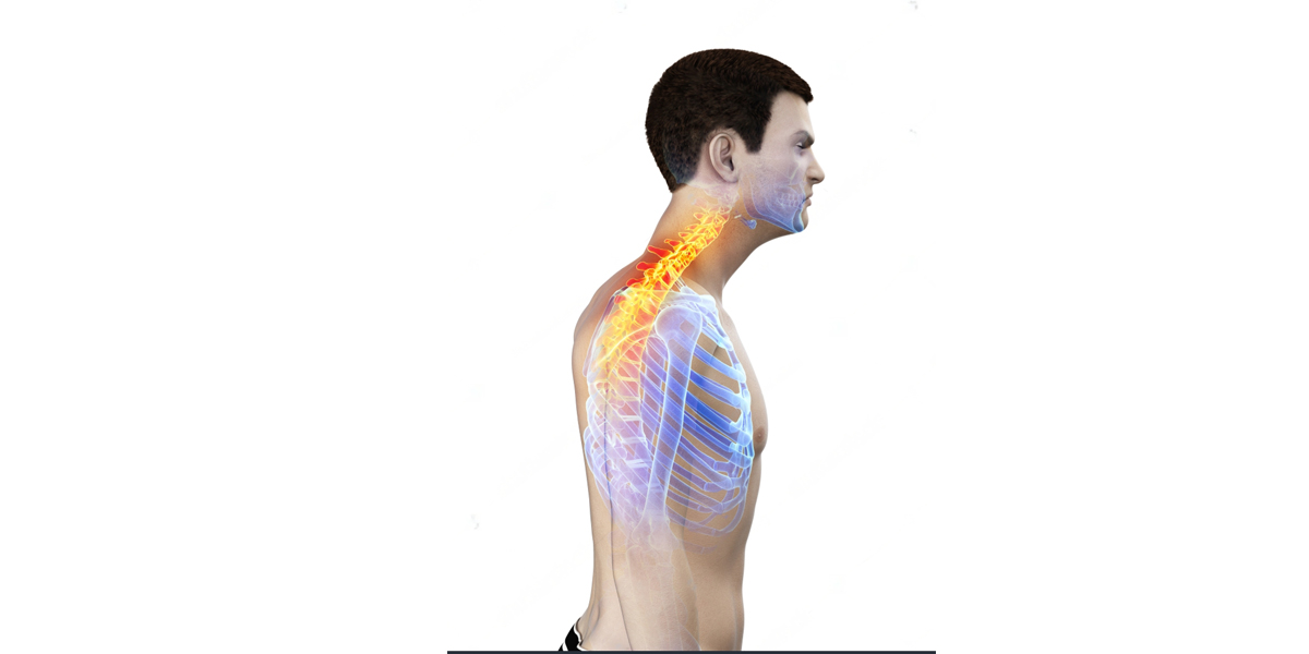 Upper Cross Syndrome and Lower Cross Syndrome